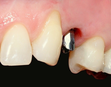 Zubní implantát a keramika 1